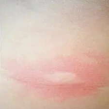 Puntura di formica rossa