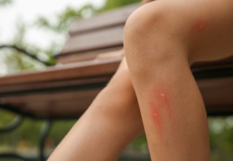 Punture di insetti: come riconoscerle, prevenirle e trattarle